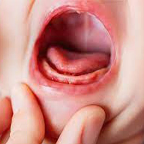 التهاب اللثة عند الأطفال