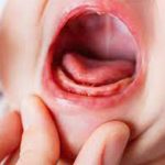 التهاب اللثة عند الأطفال