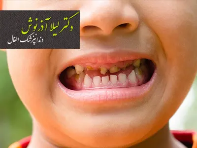 اهمیت درمان ریشه دندان شیری در کودکان