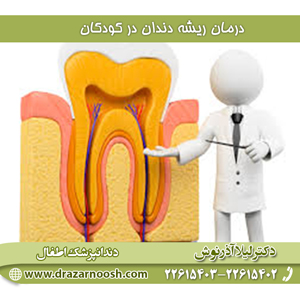 درمان ریشه دندان در کودکان