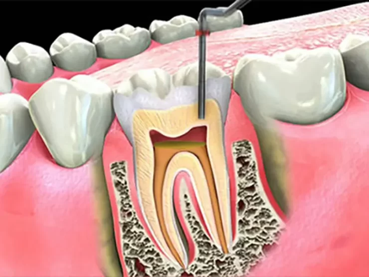 درمان ریشه دندان در کودکان