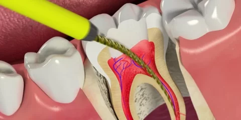 درمان ریشه دندان کودکان