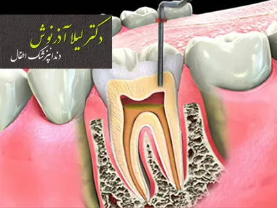 دلایل ایجاد عفونت در ریشه دندان