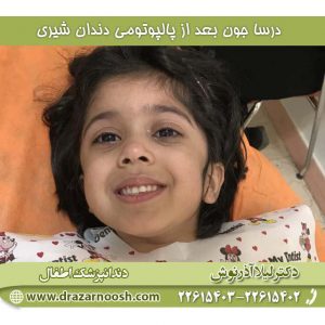 پالپوتومی دندان در کودکان