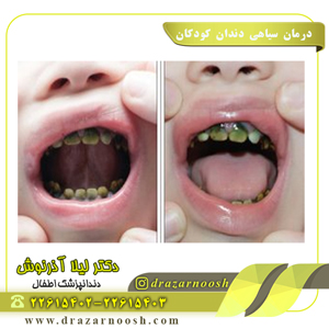 درمان سیاهی دندان کودکان