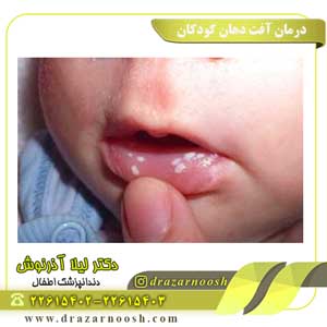 درمان آفت دهان کودکان