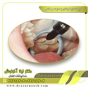 درد دندان کودکان بعد از عصب کشی