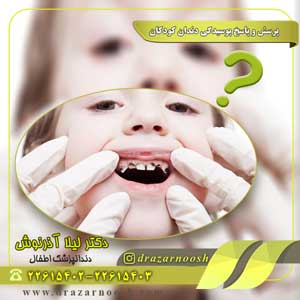 پرسش و پاسخ پوسیدگی دندان کودکان