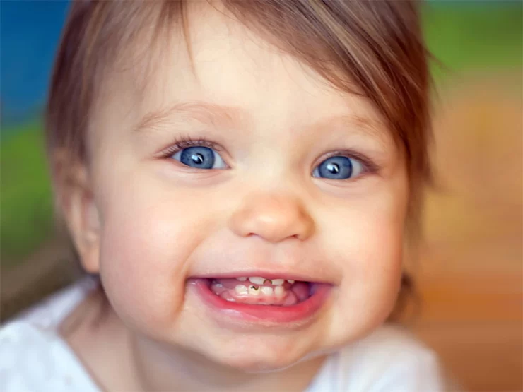 دلایل پوسیدگی دندان کودکان