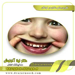 علل پوسیدگی دندان در کودکان