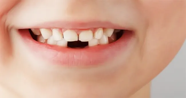 علت دیر افتادن دندان شیری