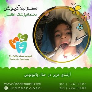 پالپوتومی اطفال