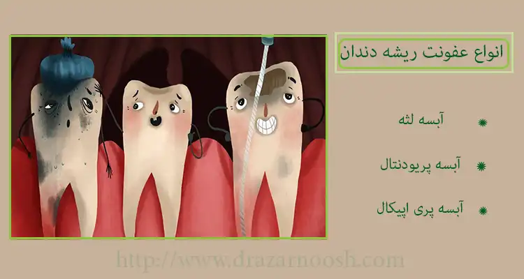 انواع عفونت دندان