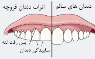 اثرات دندان قروچه