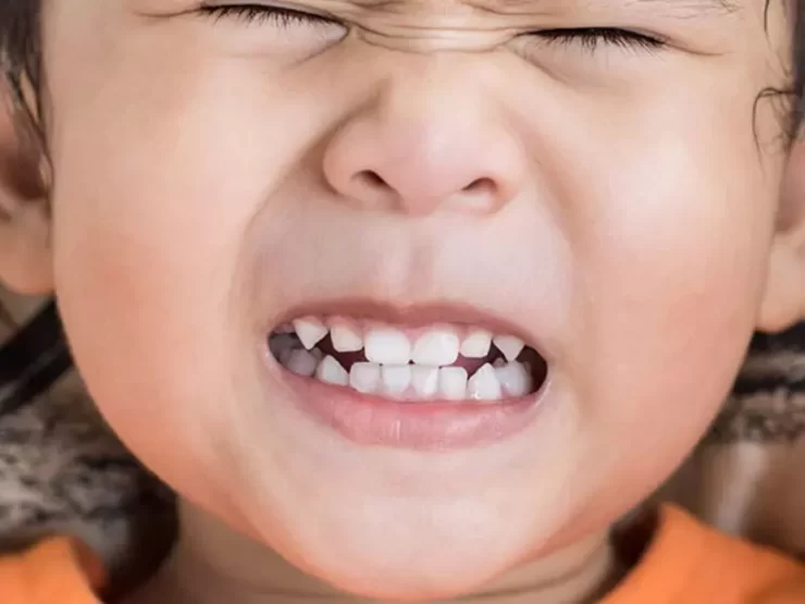 دندان قروچه در کودکان