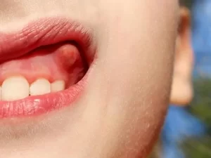 آبسه لثه