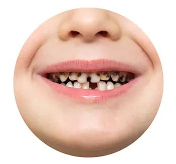 پالپوتومی دندان اطفال