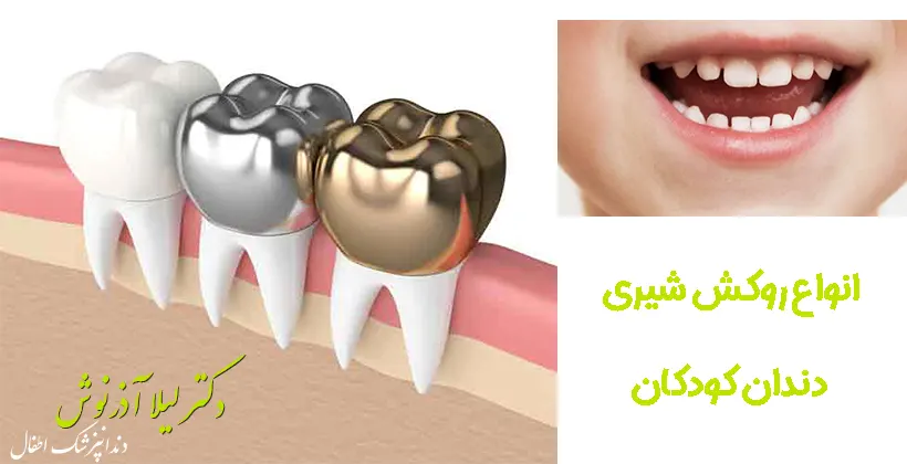 انواع روکش دندان شیری