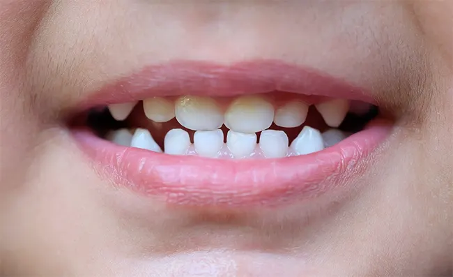 مراحل نصب روکش دندان در کودکان