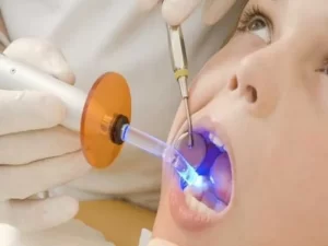 پر کردن دندان کودکان