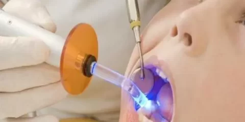 پر کردن دندان کودکان