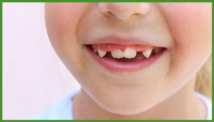 تاثیر ژنتیک در کج شدن دندان کودکان