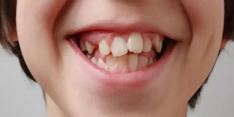 جلوگیری از کجی دندان