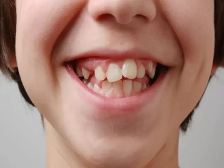 جلوگیری از کجی دندان