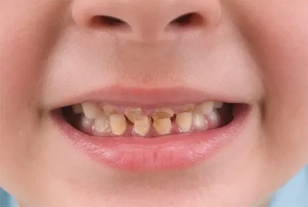 تغییر رنگ دندان کودک