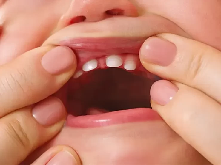 کاهش درد دندان در آوردن کودک