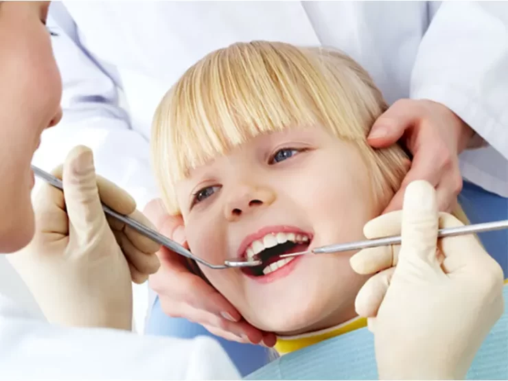 روش جرمگیری دندان کودکان