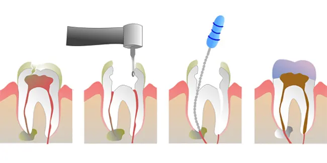 پالپکتومی دندان شیری کودکان