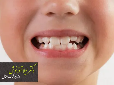 درمان دندان کج کودک