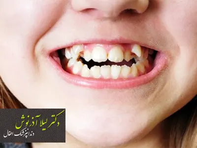 درمان قطعی کجی دندان در کودک