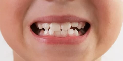 درمان کجی دندان کودکان