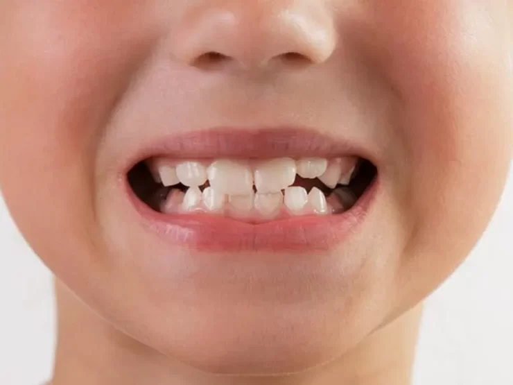 درمان کجی دندان کودکان