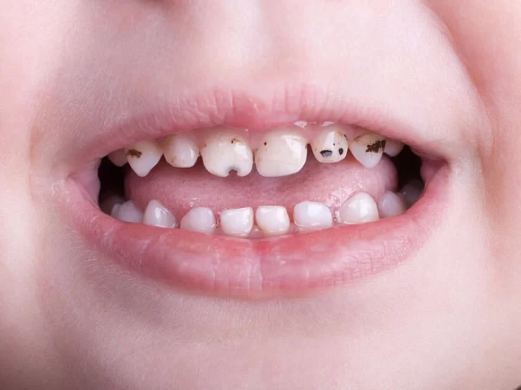 بهم ریختگی دندان کودکان