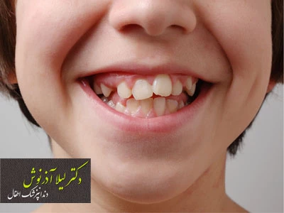  درمان بهم ریختگی دندان کودکان