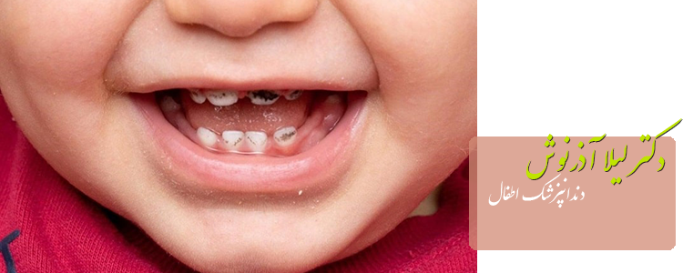 درمان سیاهی دندان کودک
