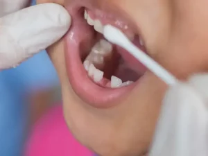 هزینه فلوراید تراپی ی دندان کودکان سال 1404