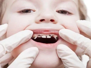 چگونه از دندان نوزادان مراقبت کنیم؟