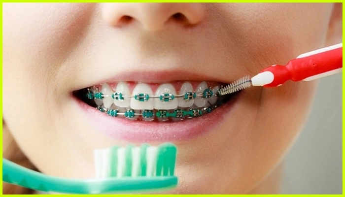 مزایای ارتودنسی دندان در دوران کودکی