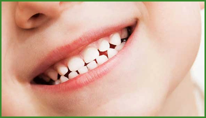 مزایای استفاده از کامپوزیت در دندان کودکان