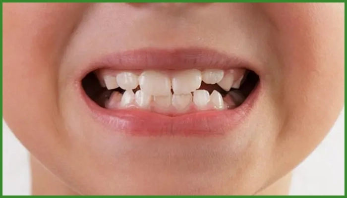 نحوه ترمیم دندان کودکان با کامپوزیت